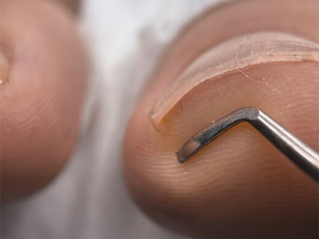 Коррекция вросшего ногтя